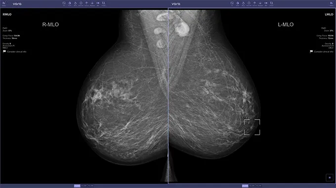 New Study Proves AI Can Improve Early Breast Cancer Detection